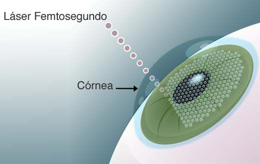 Corrección de la miopía, hipermetropía y astigmatismo mediante láser Femtosegundo
